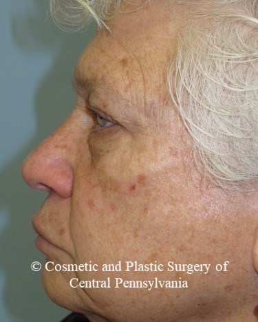 Blepharoplasty (upper eyelid) Before