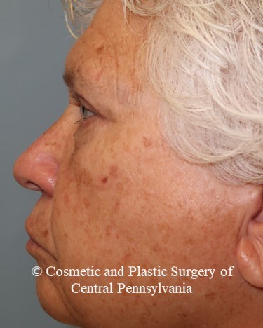 Blepharoplasty (upper eyelid) After