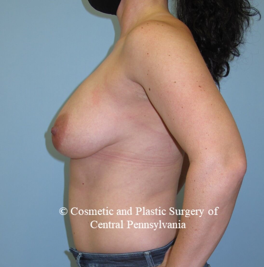 Breast Lift (Mastopexy) Before