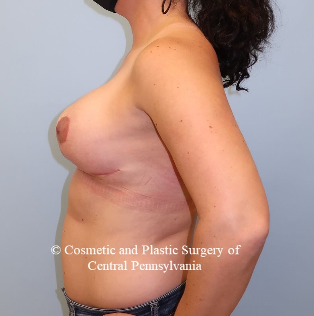 Breast Lift (Mastopexy) After