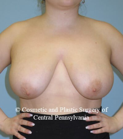 Breast Reduction Before