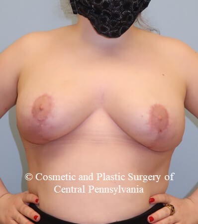 Breast Reduction After