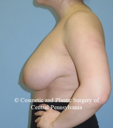 Breast Reduction Before