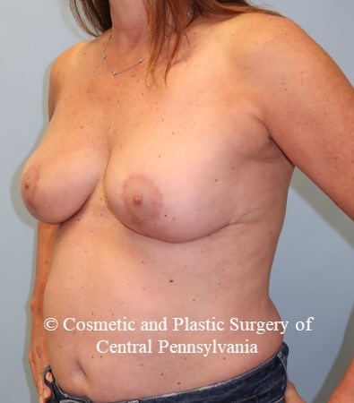 Breast Lift - mastopexies After