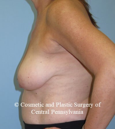 Breast Lift - mastopexies Before