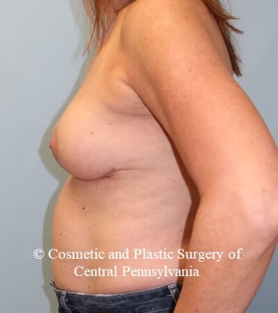 Breast Lift - mastopexies After