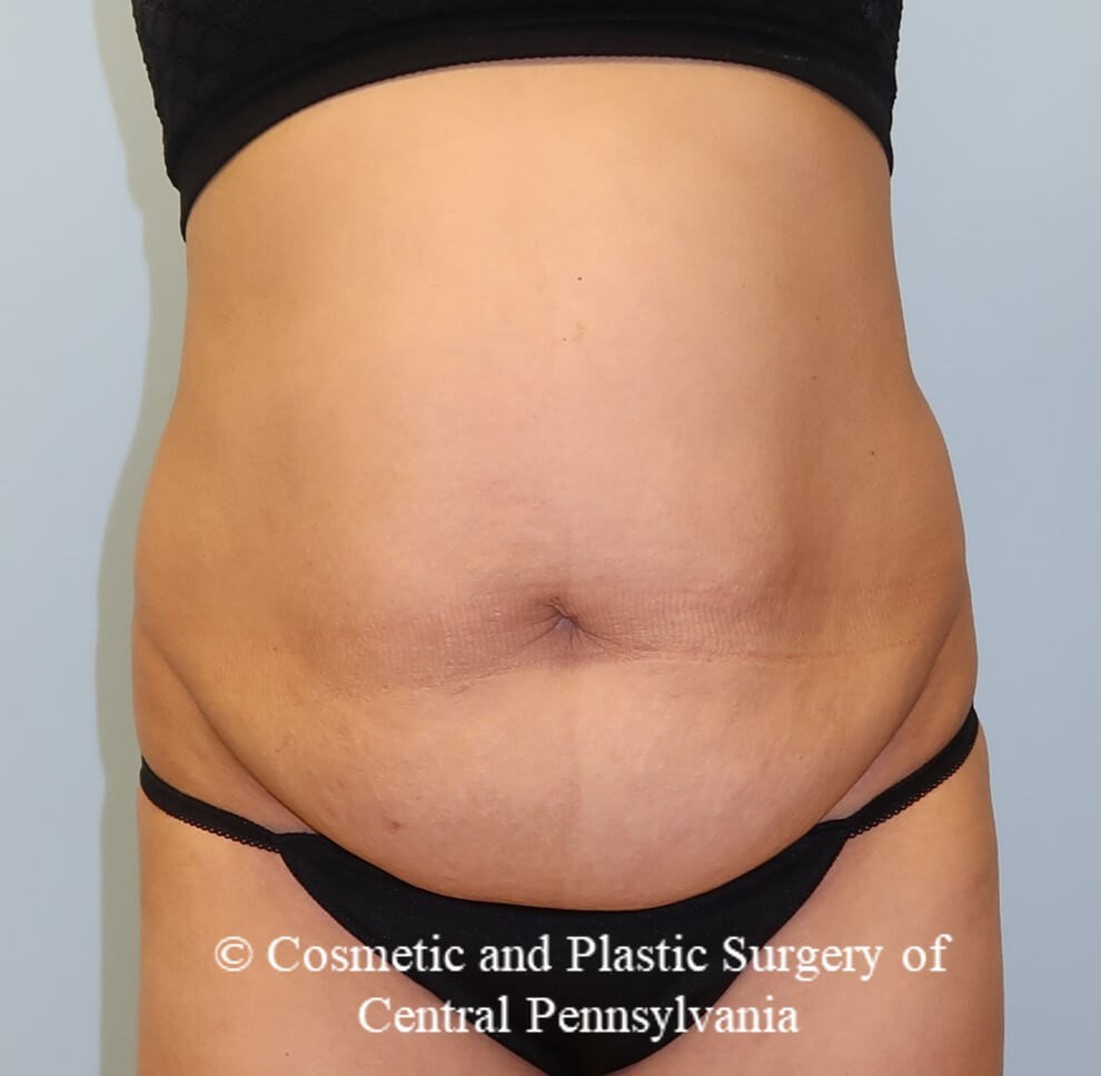 Abdominoplasty Before