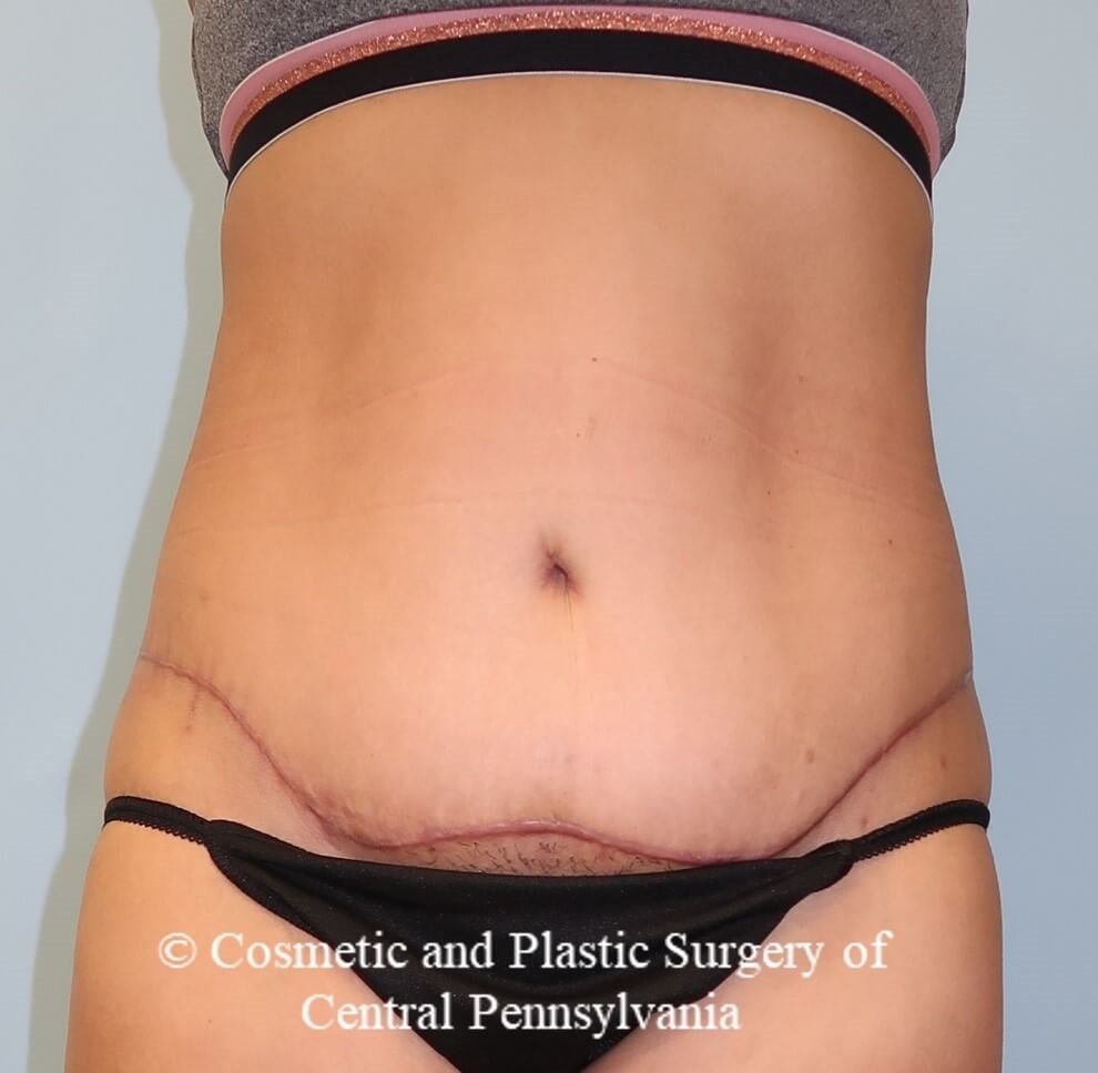Abdominoplasty After