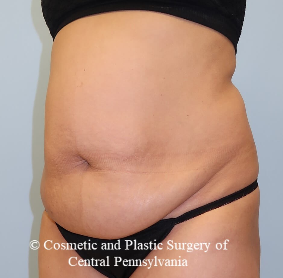 Abdominoplasty Before