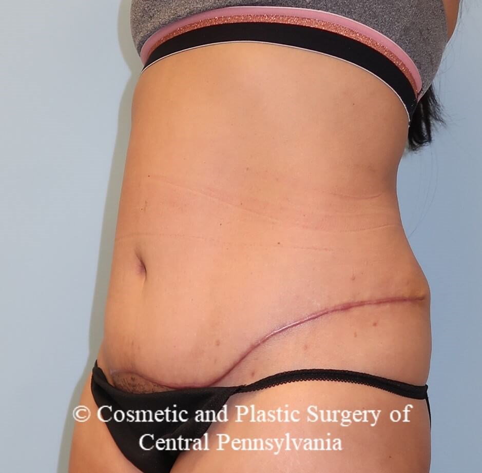 Abdominoplasty After