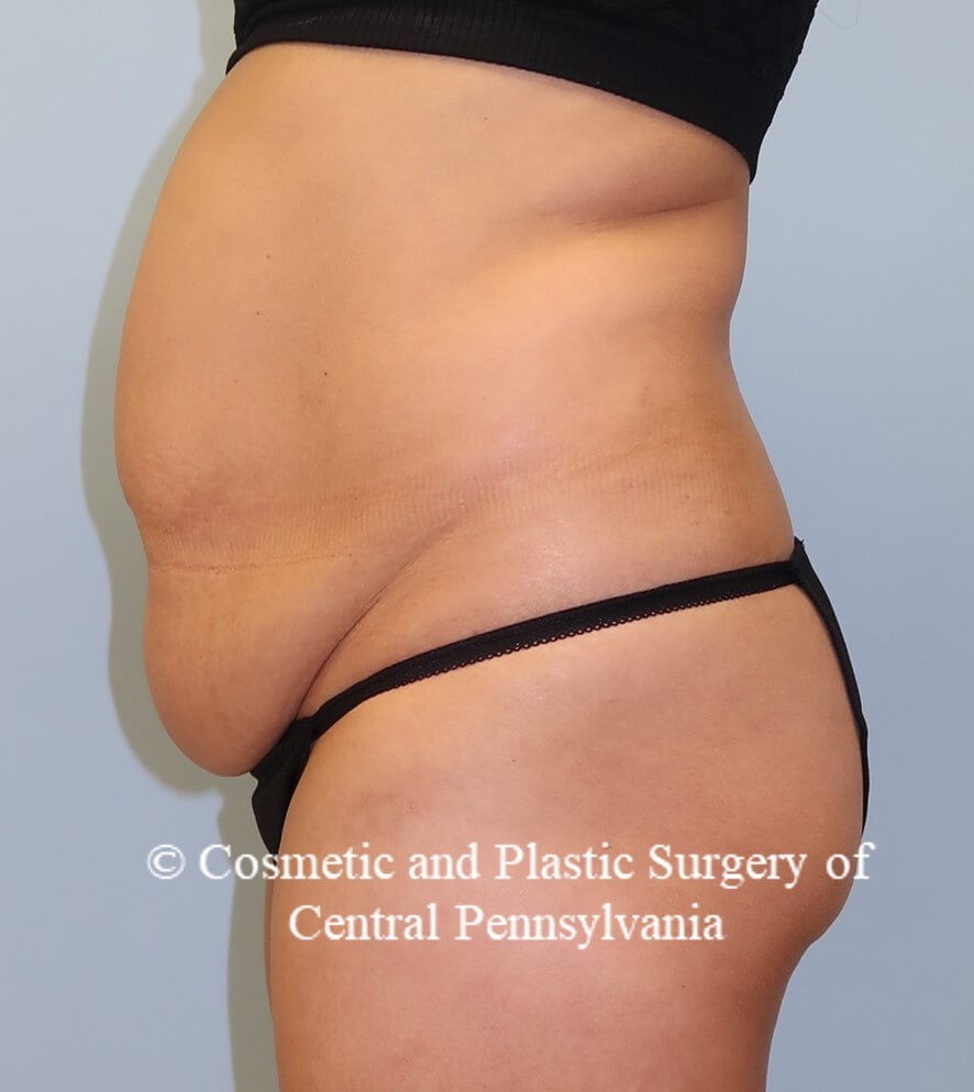 Abdominoplasty Before