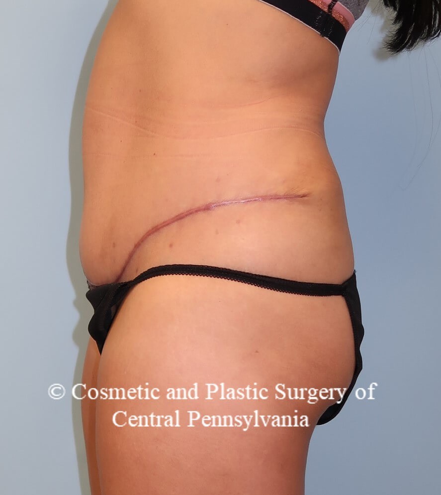 Abdominoplasty After