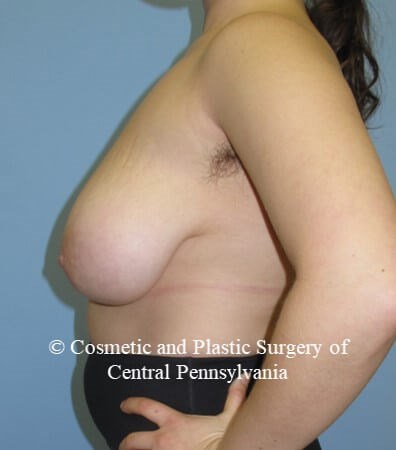 Breast Reduction Before