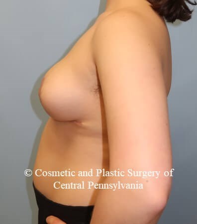 Breast Reduction After