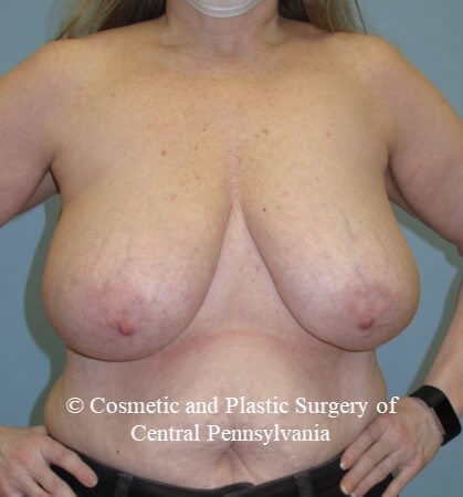 Breast Reduction Before
