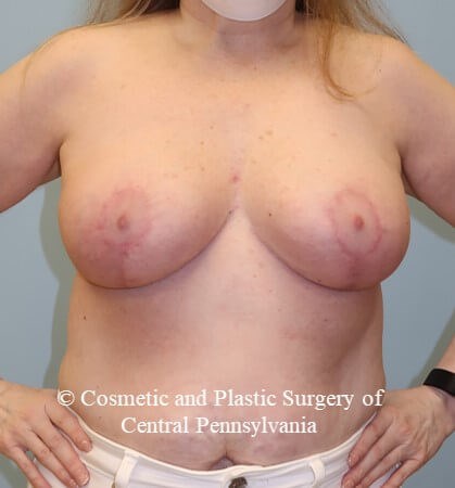 Breast Reduction After