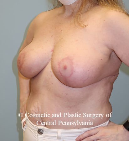 Breast Reduction After