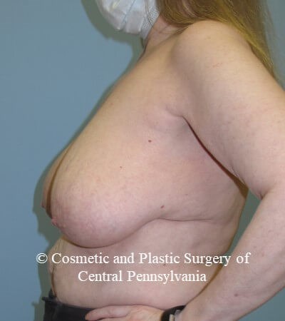 Breast Reduction Before
