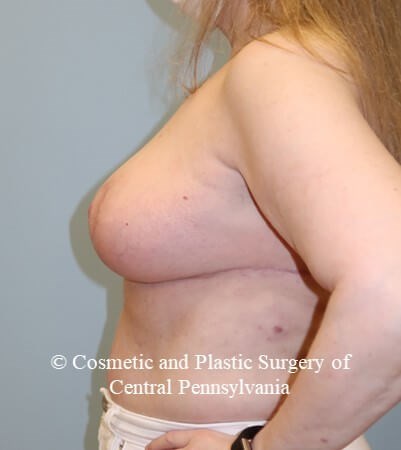 Breast Reduction After