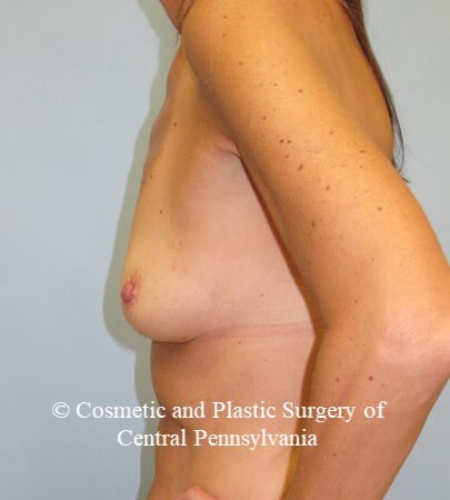 Breast Reconstruction Before