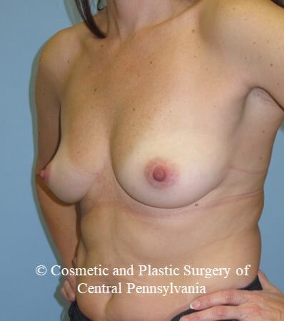 Breast Reconstruction Before