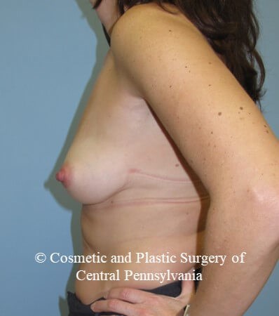 Breast Reconstruction Before