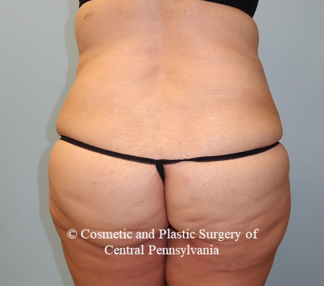 Circumferential Body Lift Before