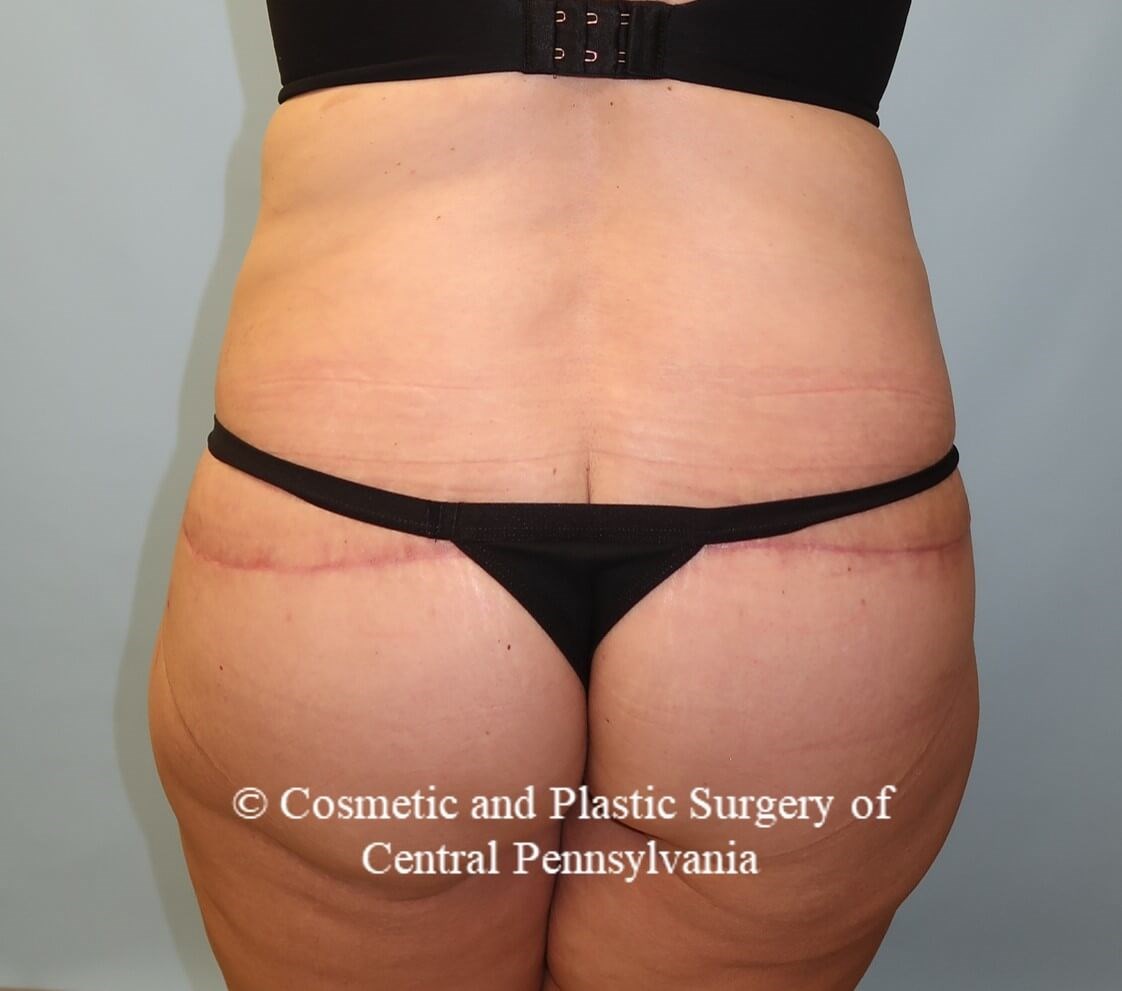 Circumferential Body Lift After