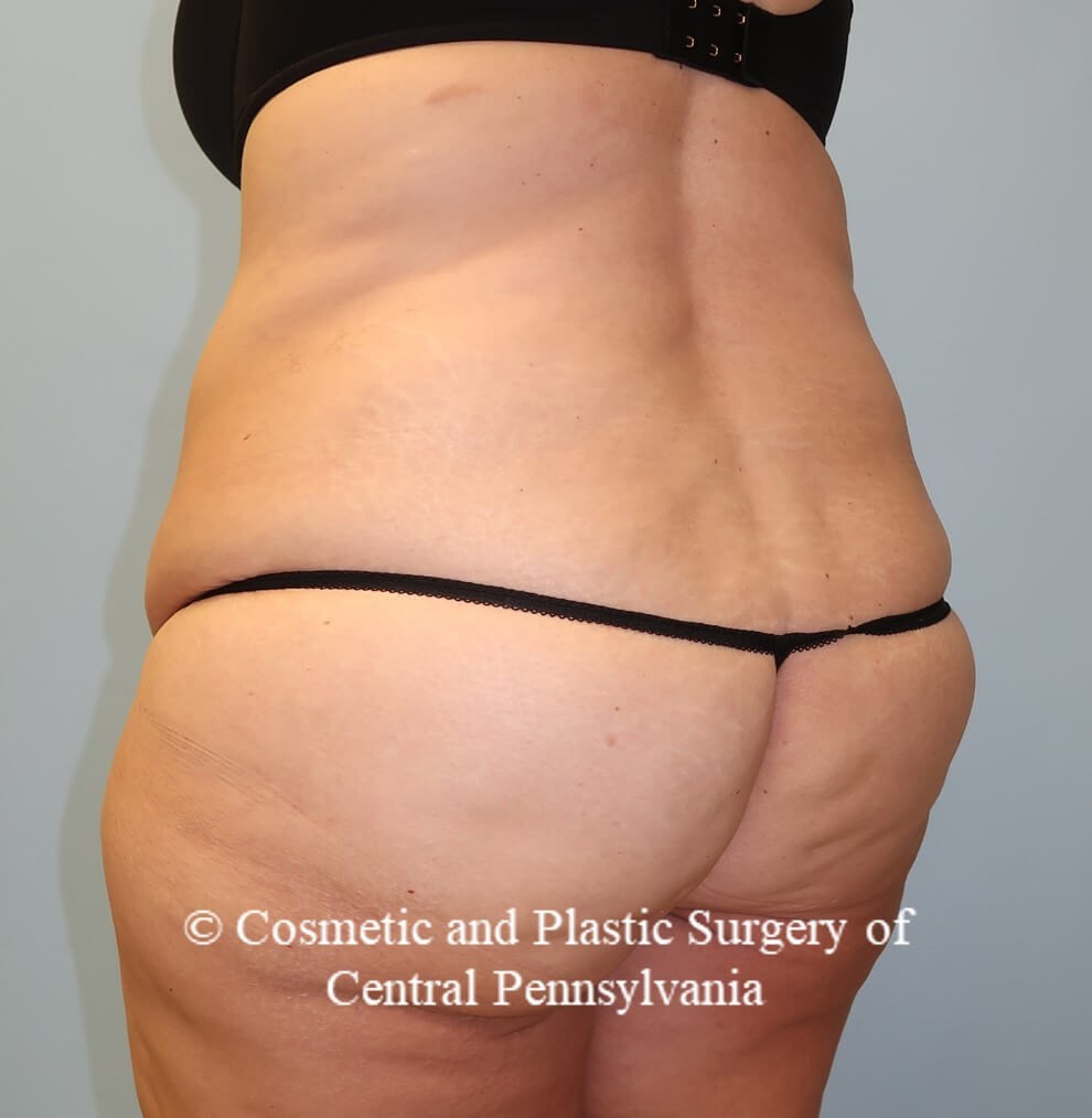 Circumferential Body Lift Before