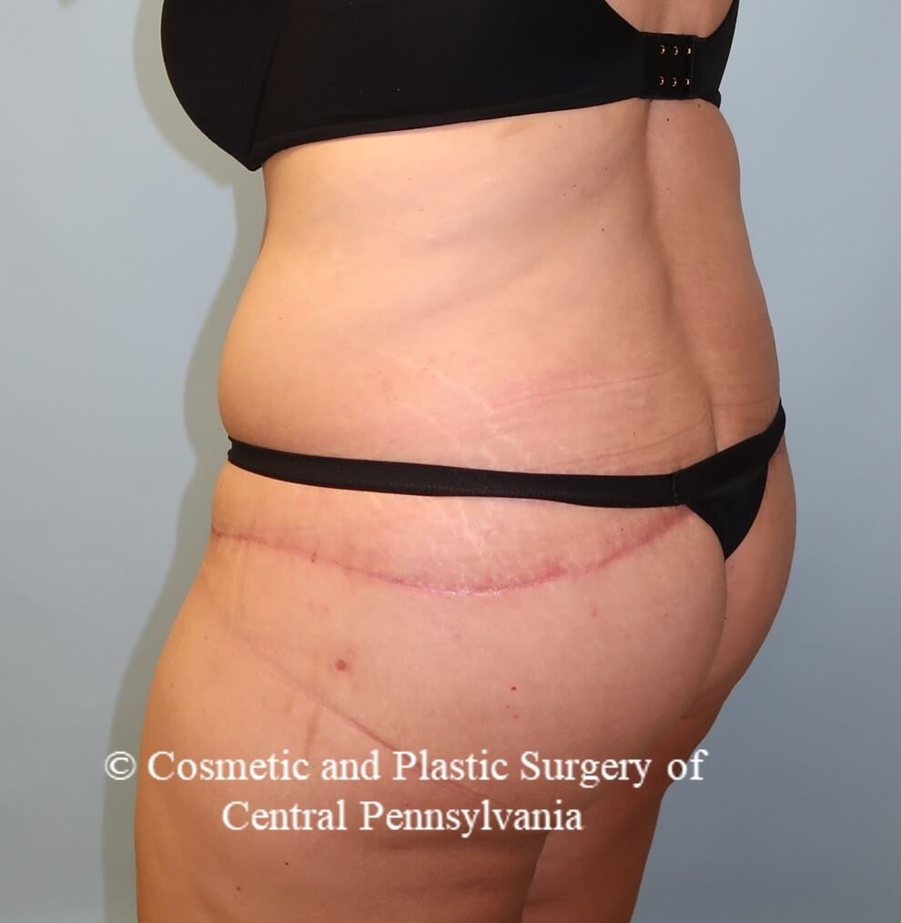 Circumferential Body Lift After