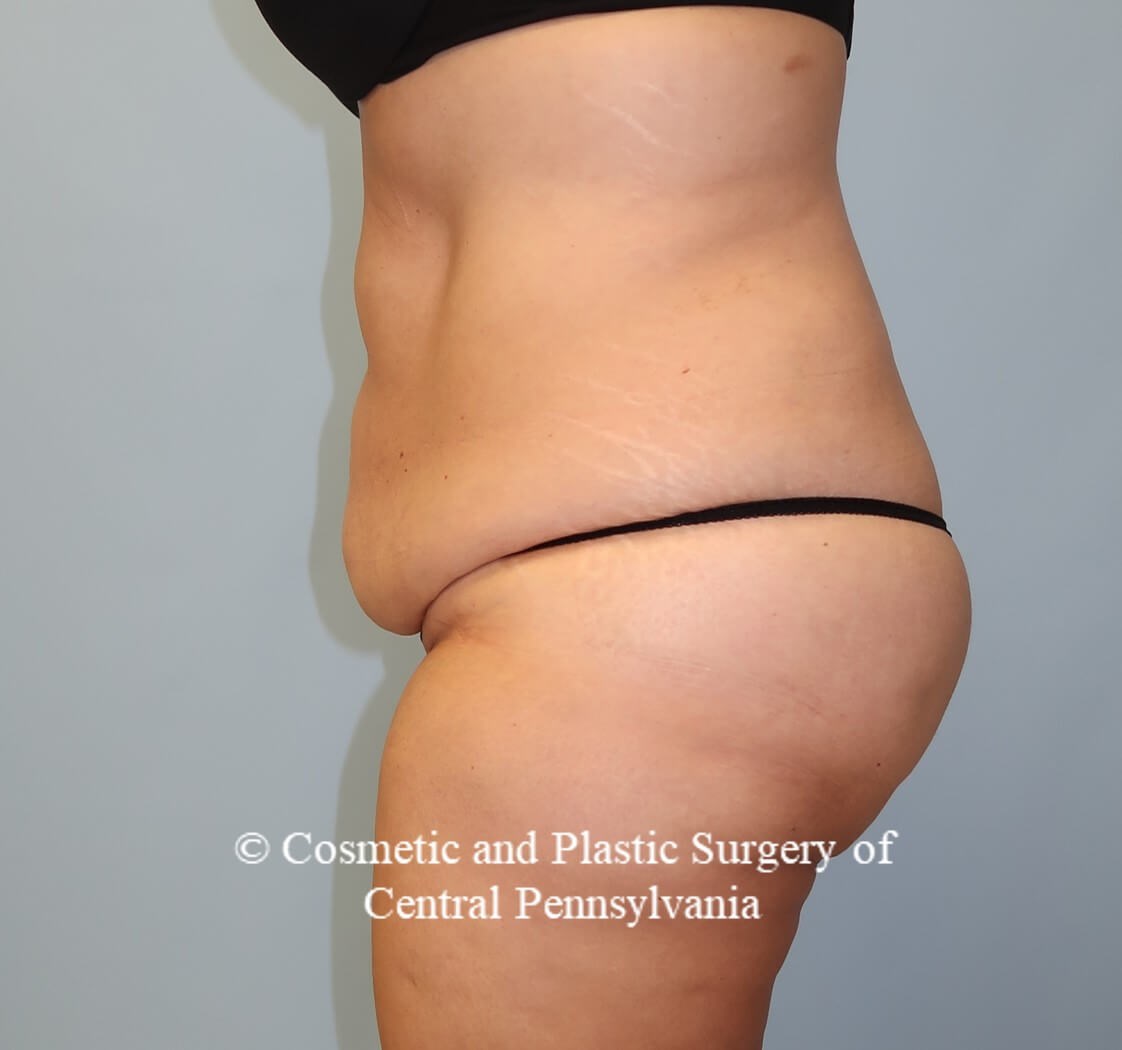 Circumferential Body Lift Before