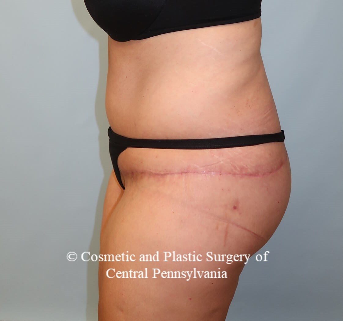 Circumferential Body Lift After