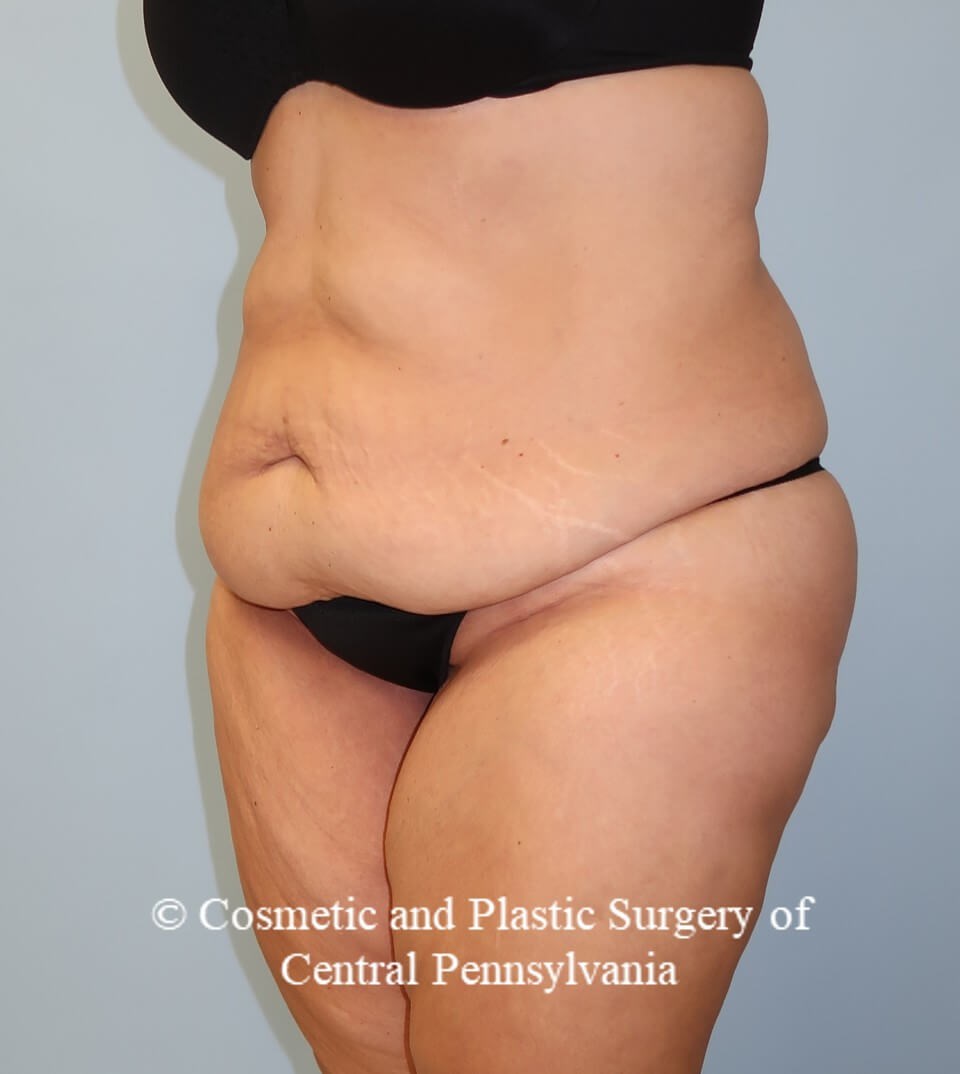 Circumferential Body Lift Before