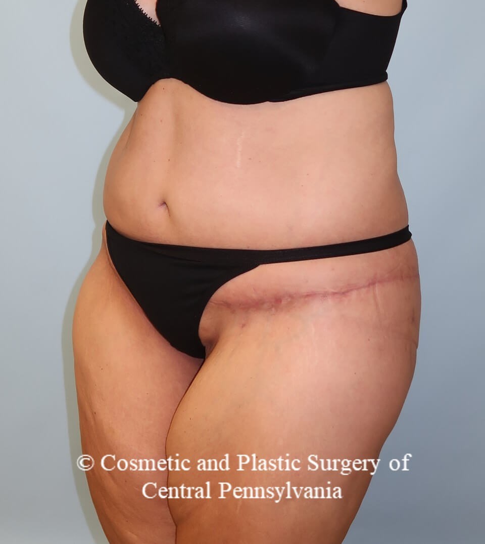 Circumferential Body Lift After